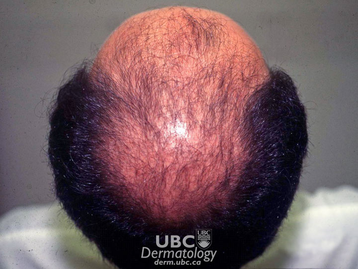 hair disorders-3 androgenetic alopecia