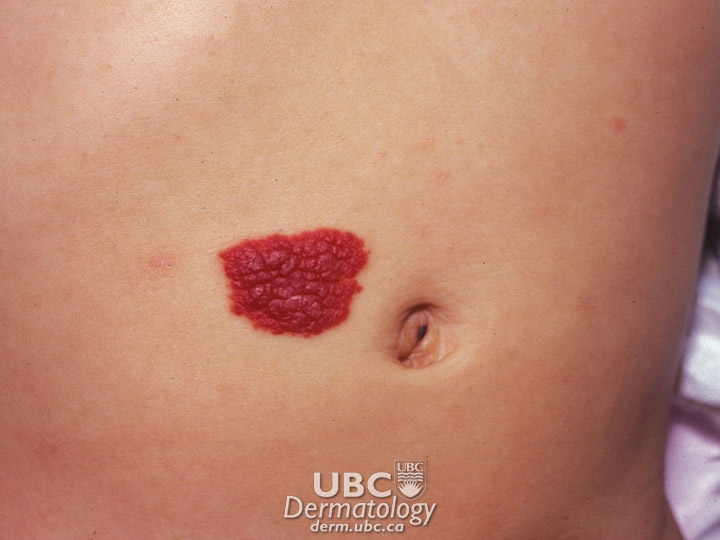 birthmark-3 hemangioma