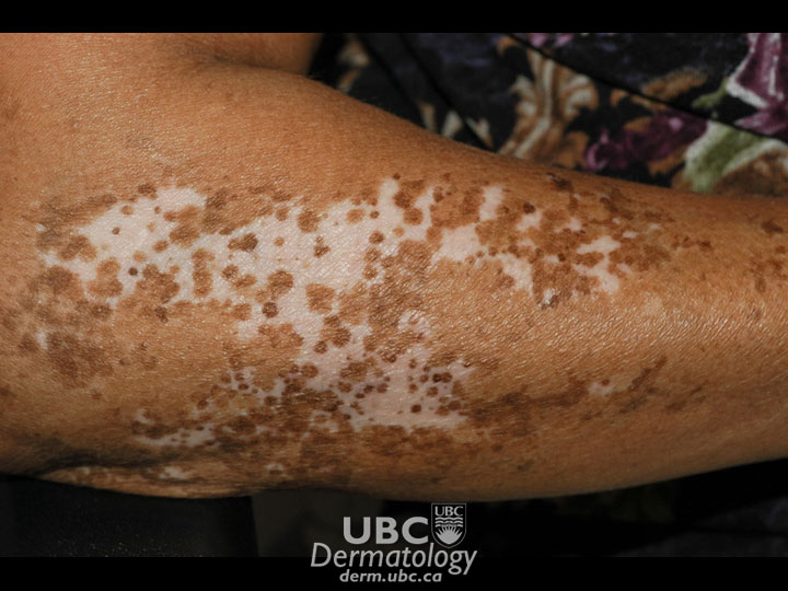 vitiligo-3